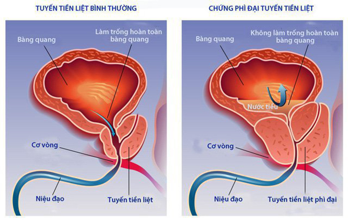 Phì đại tiền liệt tuyến là gì?