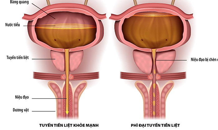 Tuyến tiền liệt ảnh hưởng đến tiết niệu nhiều hơn tình dục