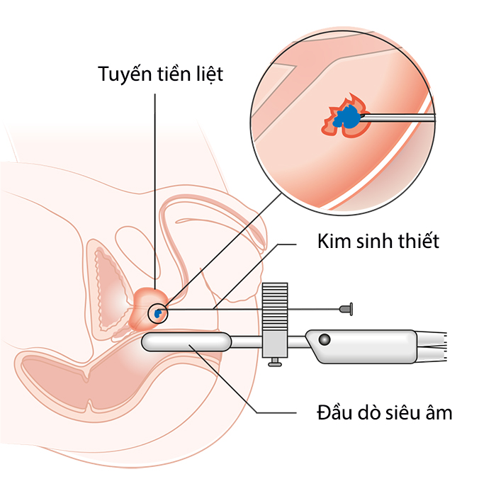 Sinh thiết tuyến tiền liệt là gì