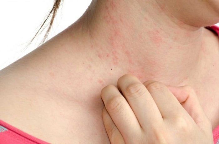 Người dị ứng với nấm linh chi