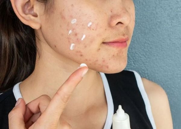 Bôi kem trị mụn bao lâu thì rửa mặt?