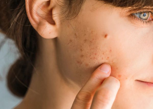 Bôi serum bị châm chích - cách xử lý như nào?