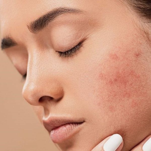 Bôi serum bị nổi mụn có sao không? Phân loại các loại mụn có thể gặp