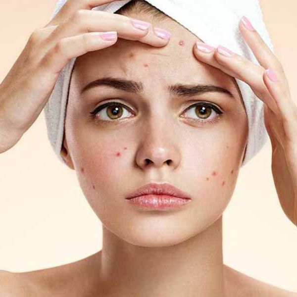 Cách bôi kem chống nắng cho da mụn