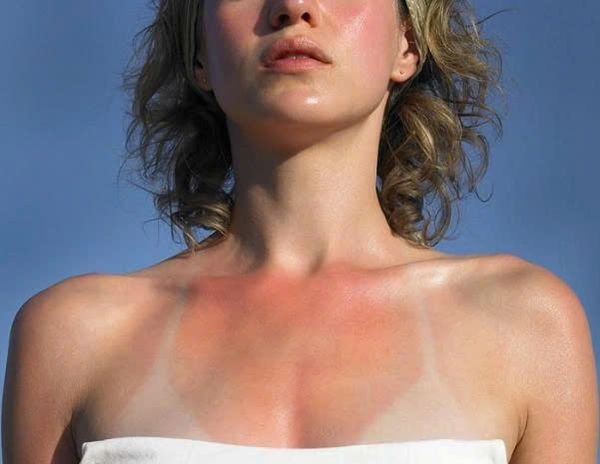 Cách phục hồi da bị cháy nắng nhanh nhất 2024