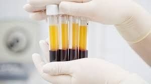 Hiểu đúng về liệu pháp cấy máu tự thân (PRP) và tác dụng với da