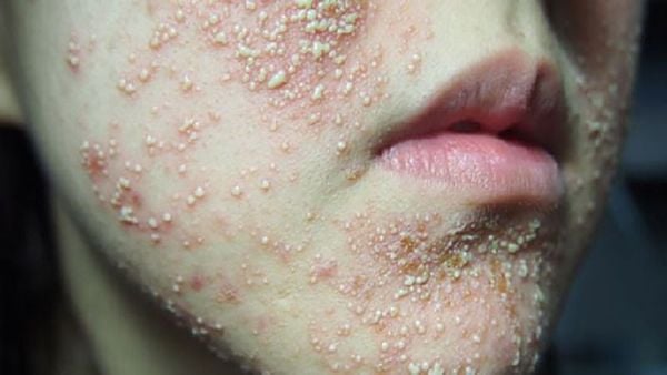 Dấu hiệu xuất hiện sau một thời gian ngắn sử dụng: Phản ứng chậm của làn da