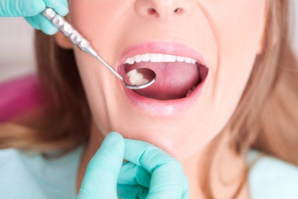 Phương pháp ngăn ngừa cao răng