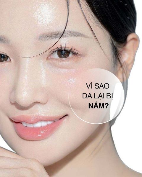 Nám tàn nhang ở da là gì? Vì sao da lại bị nám & Cách thoát khỏi nám hiệu quả