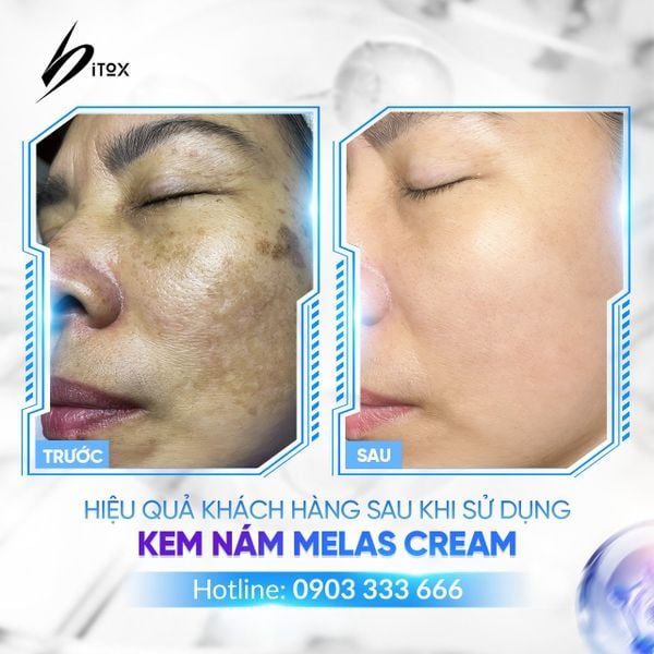 hình ảnh trước và sau khi khách hàng trị nám