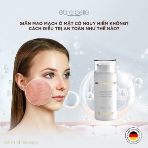 GIÃN MAO MẠCH Ở MẶT CÓ NGUY HIỂM KHÔNG? CÁCH ĐIỀU TRỊ AN TOÀN NHƯ THẾ NÀO?