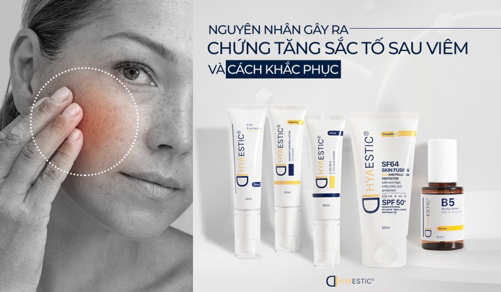 Nguyên nhân gây ra chứng tăng sắc tố sau viêm và cách khắc phục