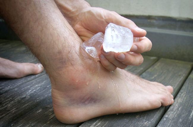cách xử lý khi bị bong gân