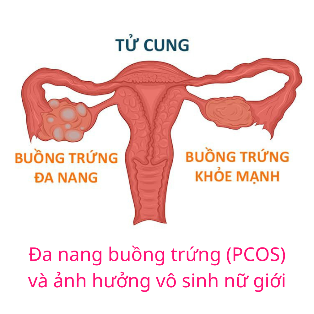 ĐA NANG BUỒNG TRỨNG PCOS VÀ VÔ SINH