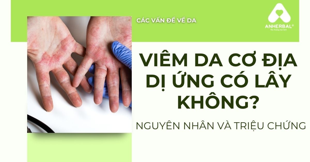 Viêm da cơ địa dị ứng có lây không? Nguyên nhân và chữa trị