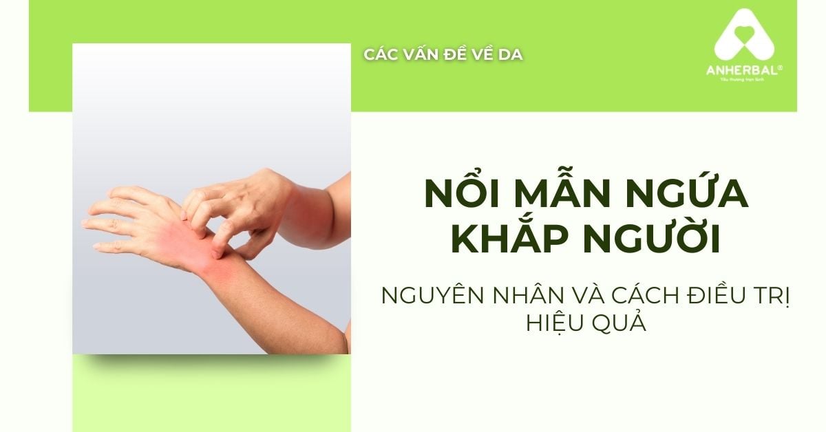 Nổi mẩn ngứa khắp người: Nguyên nhân và cách điều trị