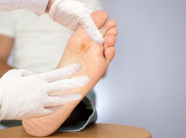 Những lưu ý trong cách chăm sóc bàn chân cho người bệnh tiểu đường