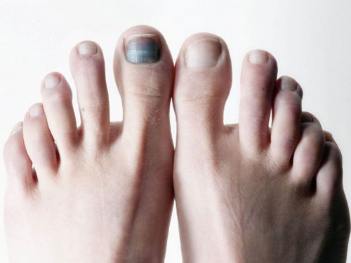 Hướng dẫn cách chăm sóc móng chân bị hư tổn không đau mau lành vết thương