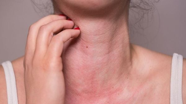 dị ứng thời tiết