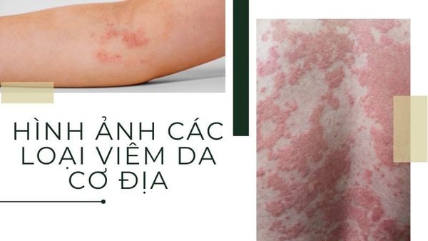 hình ảnh các loại viêm da cơ địa