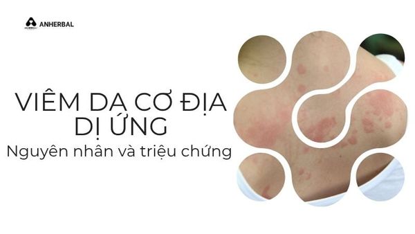 viêm da cơ địa dị ứng nguyên nhân và triệu chứng