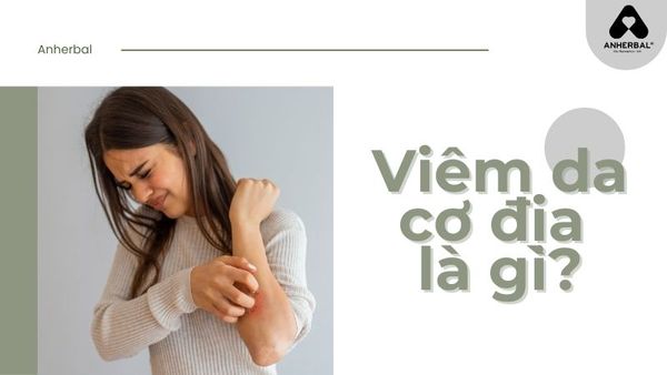 viêm da cơ địa là gì?