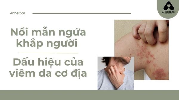 Nổi Mẩn Ngứa Khắp Người – Dấu Hiệu Viêm Da Cơ Địa?
