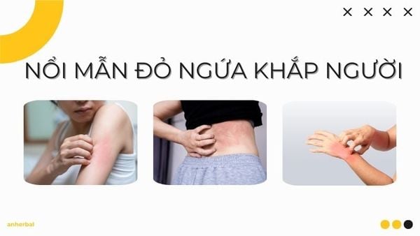 nổi mẫn đỏ ngứa khắp người