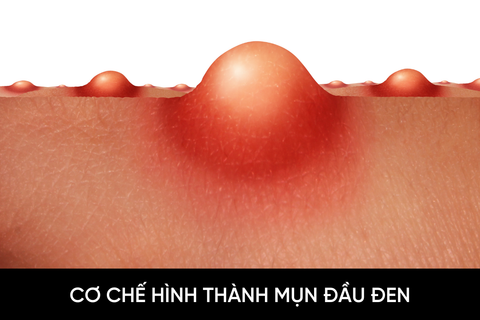 Cơ chế hình thành mụn đầu đen