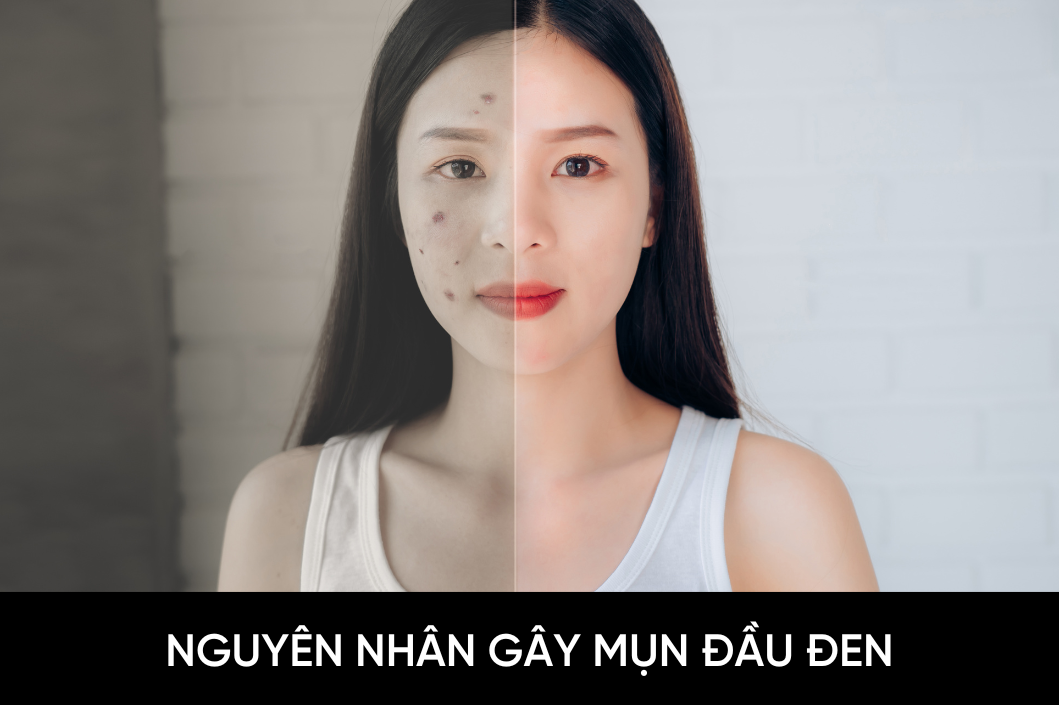 Nguyên nhân gây mụn đầu đen