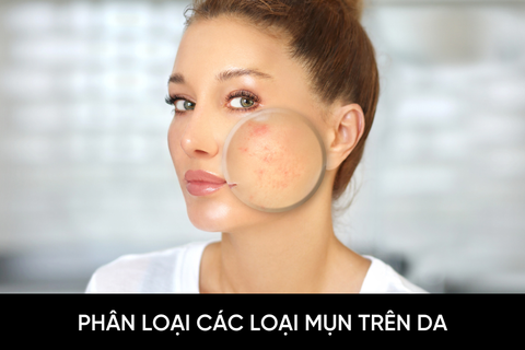 Phân loại các loại mụn trên da