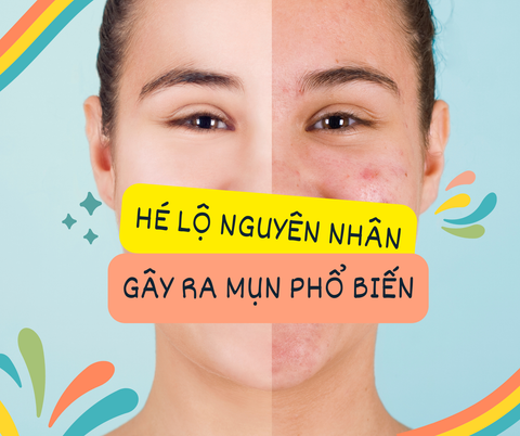 HÉ LỘ NHỮNG NGUYÊN NHÂN GÂY RA MỤN PHỔ BIẾN
