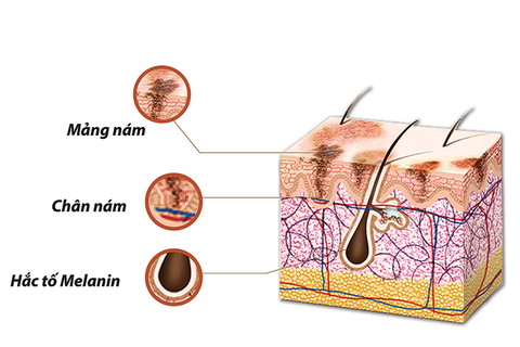 Nguyên Nhân Nám Da Và Cách Khắc Phục Nám Da Hiệu Quả