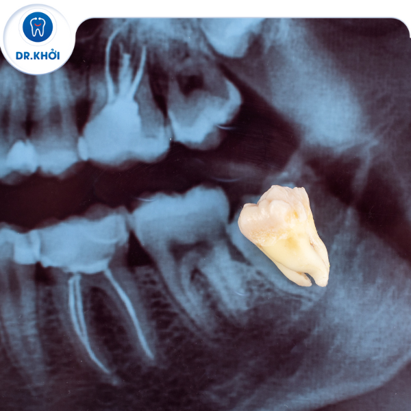 Biến chứng do răng khôn mọc lệch ngầm  Bệnh viện Hữu nghị Việt Tiệp