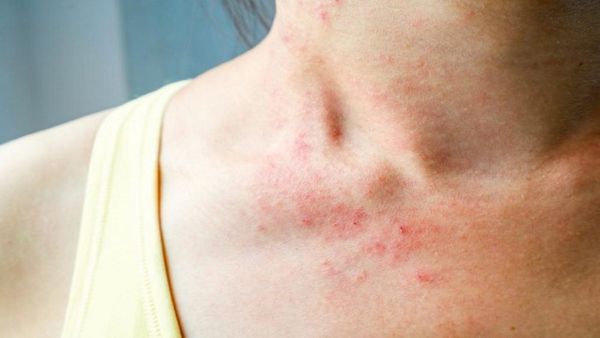 Phát ban có thể là dấu hiệu cơ thể thiếu vitamin B6
