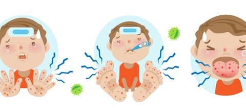 Sức khỏe -  Cách nhận biết và chăm sóc trẻ mắc Tay - Chân - Miệng