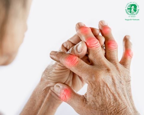 Bệnh Gout Là Gì? Nguyên Nhân, Dấu Hiệu, Biến Chứng Và Cách Phòng Ngừa