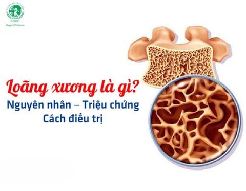 Nguyên nhân, hậu quả và cánh phòng tránh bệnh loãng xương như thế nào?