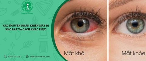 Các nguyên nhân khiến mắt bị khô rát và cách khắc phục