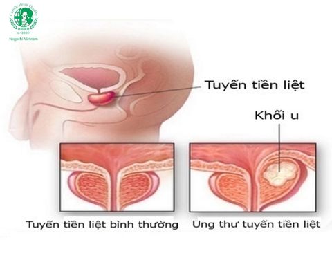 Ung thư tuyến tiền liệt: Nguy cơ tiềm ẩn và dấu hiệu cảnh báo