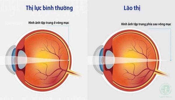 lý do tại sao người già thường phải đeo kính lão