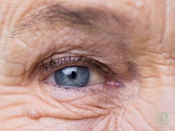 cách xử trí đột quỵ mắt