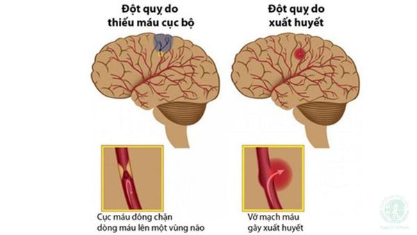 dấu hiệu đột quỵ trước 30 ngày bạn nên biết