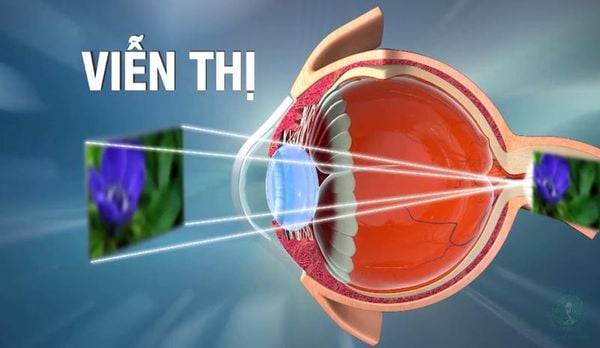 lý do mắt nhìn gần bị nhòe