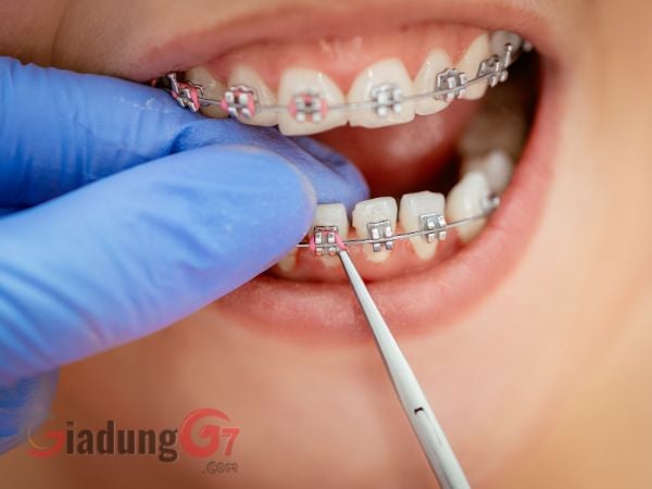 Niềng răng: Cách chăm sóc và đánh răng đúng cách