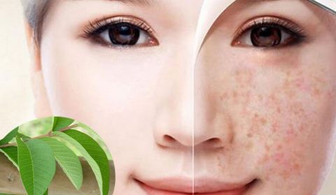 Bí quyết làm mờ vết thâm nám trên da tại nhà