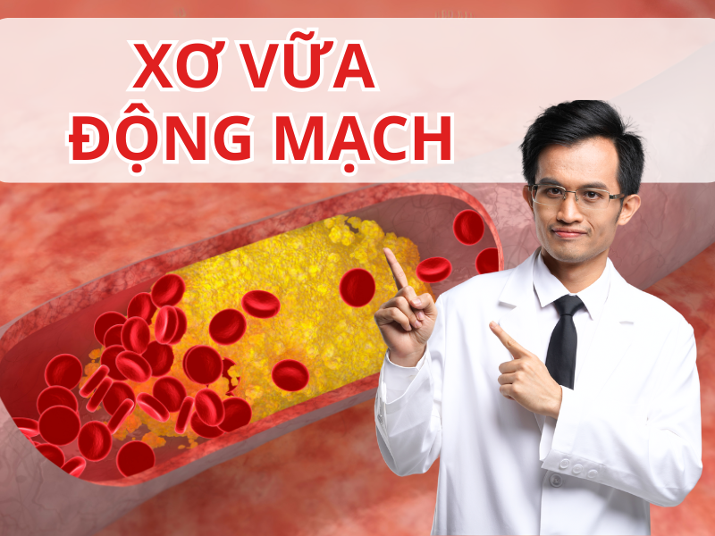 Xơ Vữa Động Mạch - Quả Bom Nổ Chậm Trong Cơ Thể