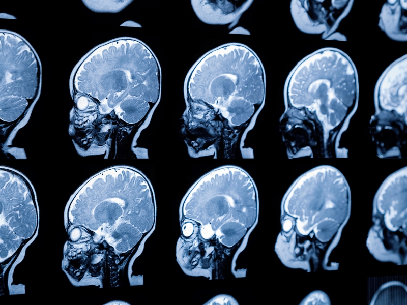 Bệnh thoái hóa chất trắng nên ăn gì?