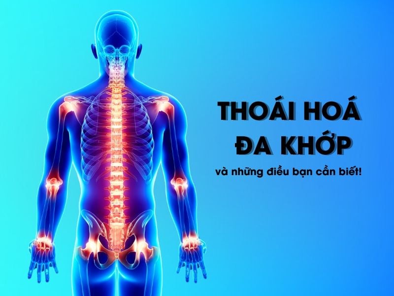 Thoái hoá đa khớp và những điều bạn cần biết