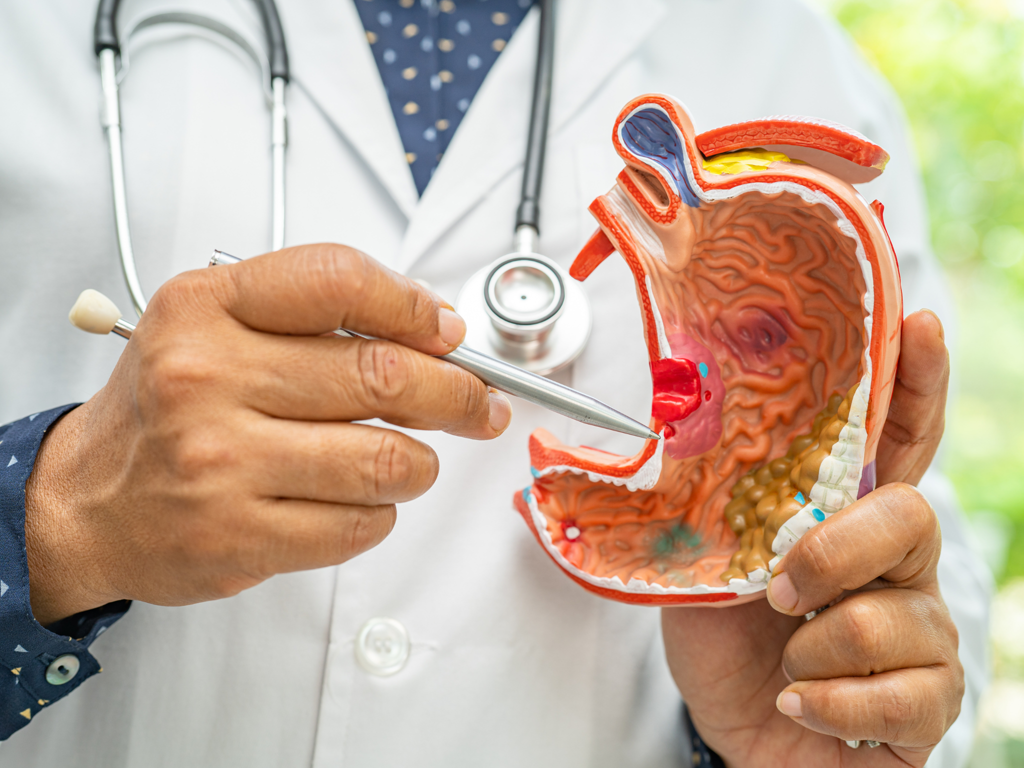 Trào ngược dạ dày: Sai lầm phổ biến và cách cải thiện hiệu quả không cần thuốc